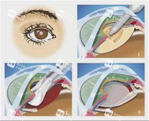 后巩膜加固术的步骤