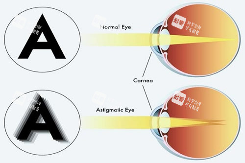 正常眼与散光眼对比 正常眼与散光眼对比