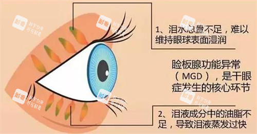 睑板腺疏通作用