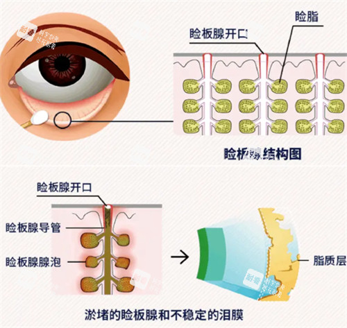 睑板腺疏通过程