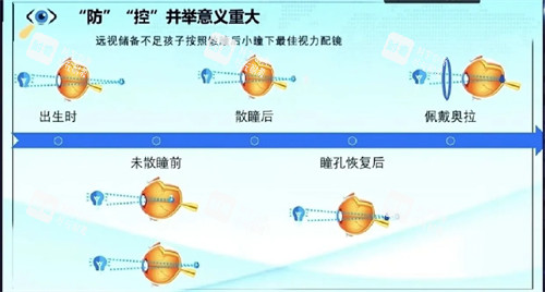 奥拉怒放离焦防控镜片佩戴过程原理