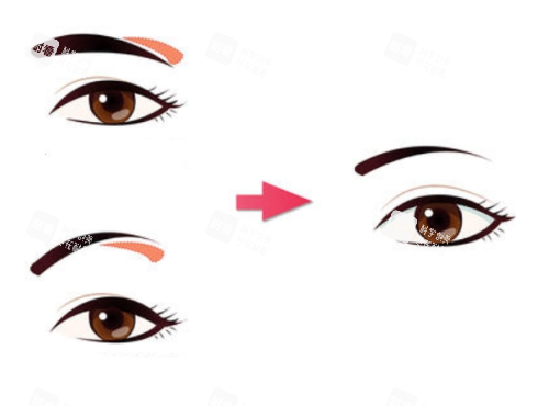 提眉手术前后对比图