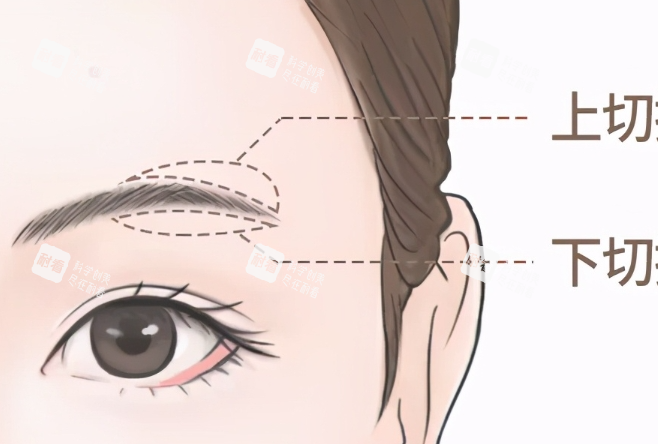 提眉上下切口示意图