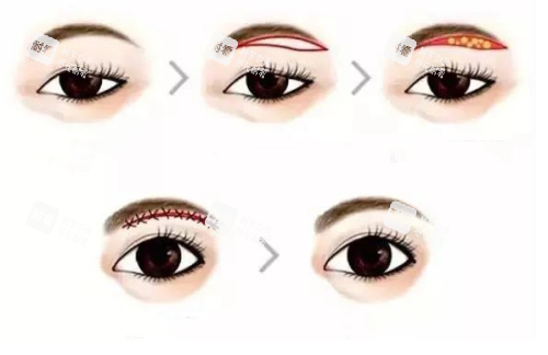 提眉手术流程示意图