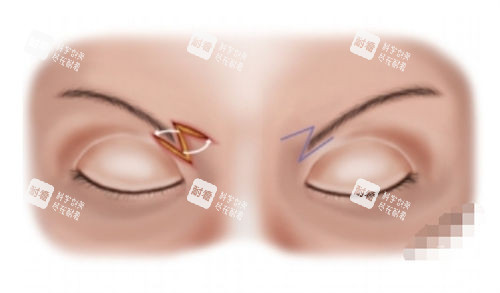 切眉部位展示