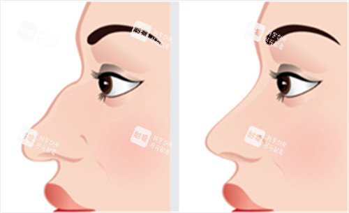 矫正驼峰鼻前后对比图 矫正驼峰鼻前后对比图