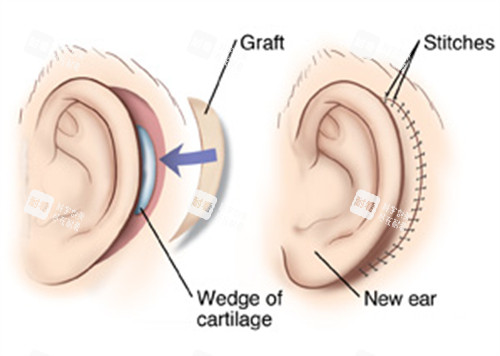 耳再造手术的切口一览 耳再造手术的切口一览