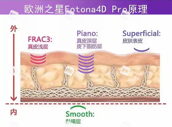 Fotona4D Pro适合年龄:30-60岁全脸+身体抗衰,四阶段分层疗法!