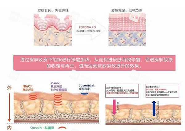 欧洲之星fotona4dpro改善皮肤示意图 欧洲之星fotona4dpro改善皮肤示意图