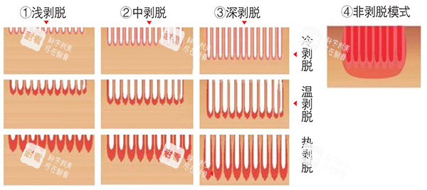 欧洲之星fotona4d各类模式照片 欧洲之星fotona4d各类模式照片