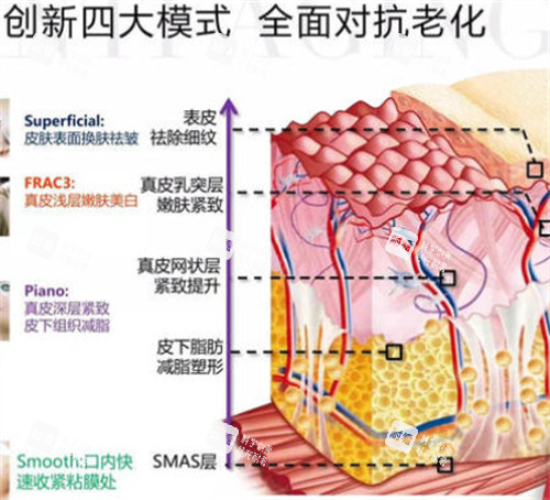 fotona4d欧洲之星不同模式对应层次 fotona4d欧洲之星不同模式对应层次