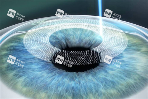 全飞秒手术动画图 全飞秒手术动画图