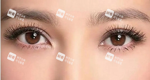 开眼角.webp 开眼角.webp