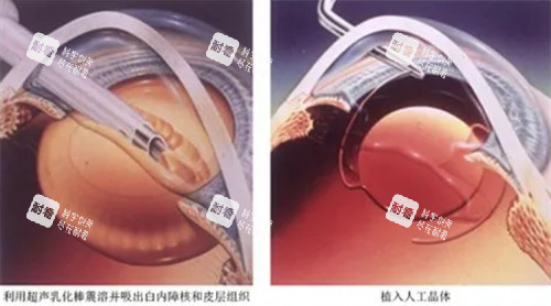 超声乳化白内障