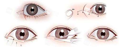 开眼角手术方法 开眼角手术方法