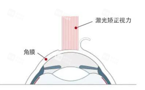 激光近视矫正改善 激光近视矫正改善