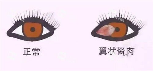 翼状胬肉与正常眼睛对比图 翼状胬肉与正常眼睛对比图