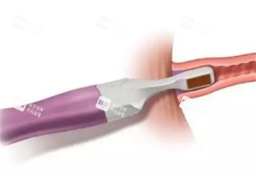 viveve薇蜜私密紧致仪器治疗过程图解 viveve薇蜜私密紧致仪器治疗过程图解