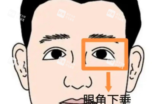 眼角下垂漫画示意图