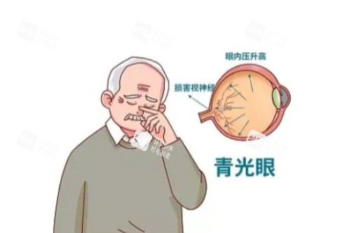 青光眼卡通图 青光眼卡通图