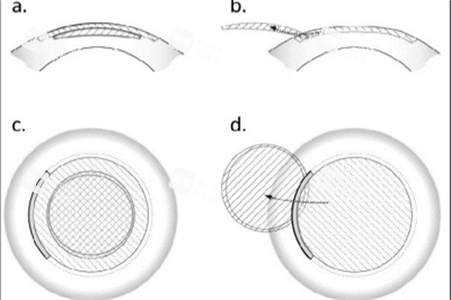 民众眼科+兰州爱尔联合优惠：摘镜套餐仅1.2万，双城手术可预约！