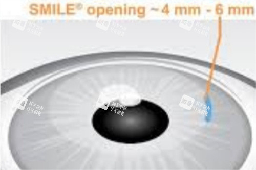 全飞秒创口示意图