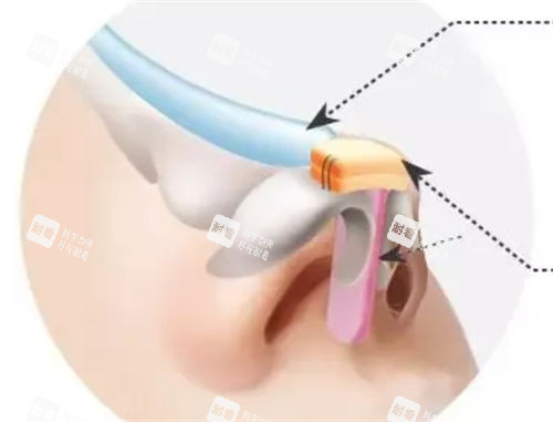 隆鼻假体植入鼻背动画展示图 隆鼻假体植入鼻背动画展示图