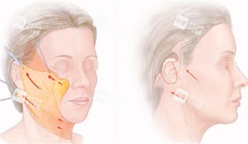 拉皮手术前后成果对比展示图 拉皮手术前后成果对比展示图