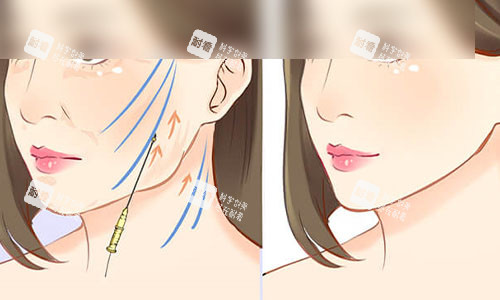 拉皮手术成效示意图