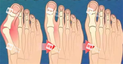 不同程度的大脚骨