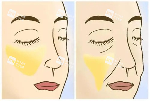 面部脂肪填充示意图