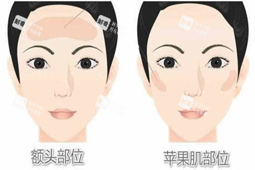 脂肪填充部位展示图