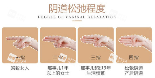 阴道松弛程度图示 阴道松弛程度图示
