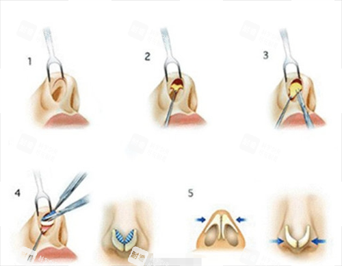 鼻小柱延长手术过程展示图