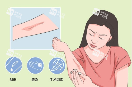 疤痕增生引起的因素示意图