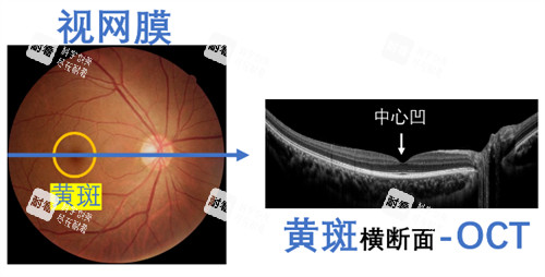 黄斑眼病横切面的样子图解
