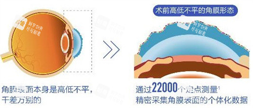 个性化飞秒术前