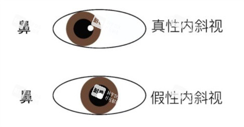 斜视的类型