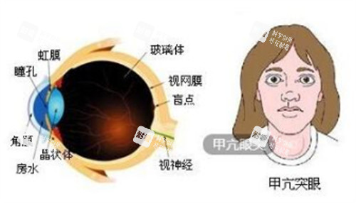 甲亢突眼给眼球带来的变化图解 甲亢突眼给眼球带来的变化图解