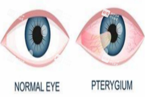 翼状胬肉眼睛与正常眼对比 翼状胬肉眼睛与正常眼对比