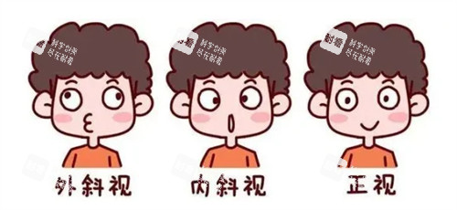 外斜内斜和正常眼睛的对比图