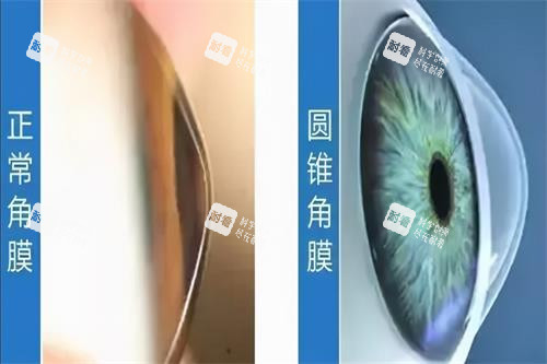 圆锥角膜和正常角膜的区别