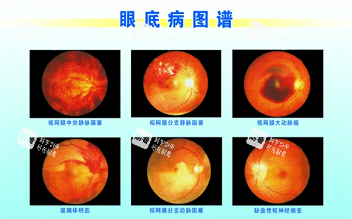 眼底病图谱示意图