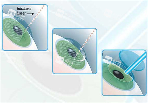 南京东南眼科近视手术过程图解 南京东南眼科近视手术过程图解