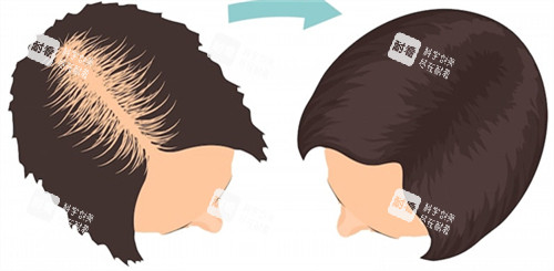 毛发种植前后对比 毛发种植前后对比