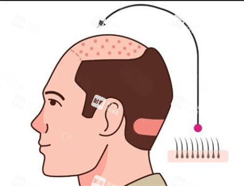 毛发种植 毛发种植