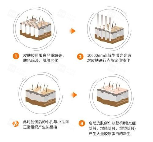 点阵激光的治疗步骤