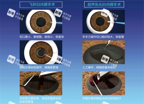 飞秒白内障手术过程图