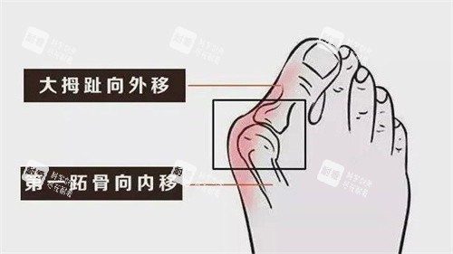 大脚骨的症状