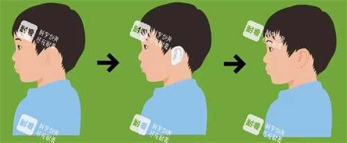 小耳畸形手术前后对比